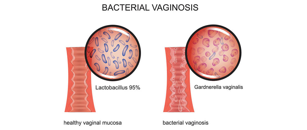 illustration-healthy-bacterial-vaginosis | American Pregnancy Association