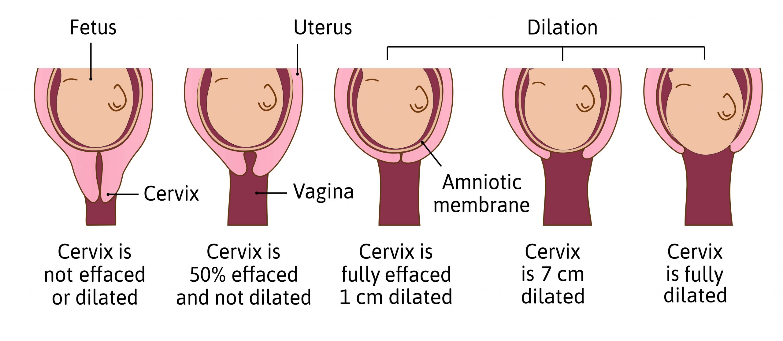 What is Dilation in Pregnancy?