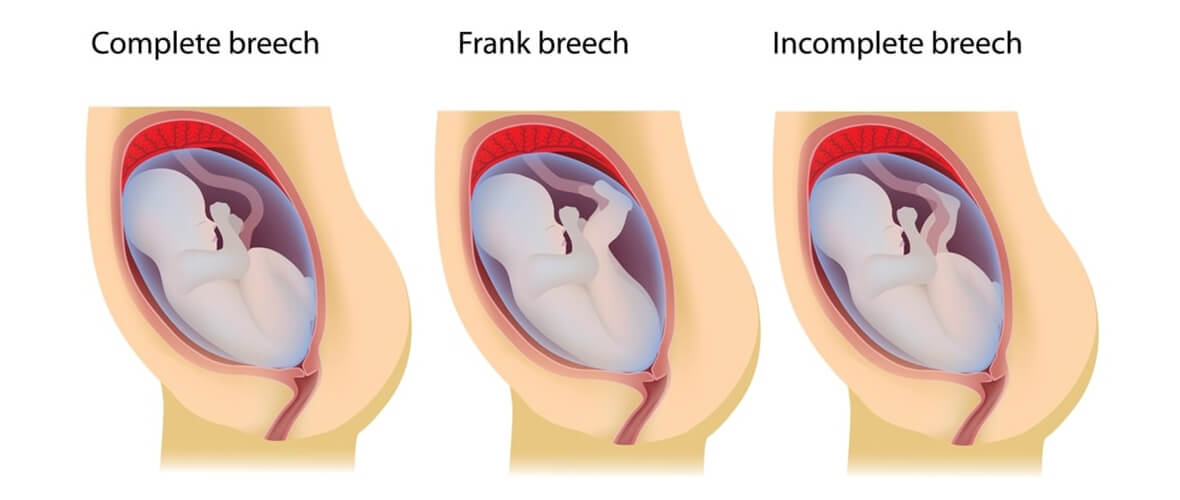 graphic-image-three-types-of-breech-births | American Pregnancy Association