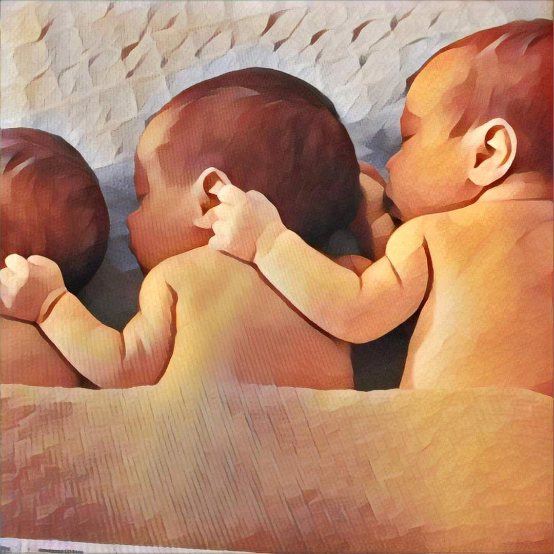 Multiples Pregnancy: Twins, Triplets and More
