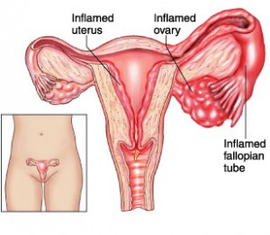 Pelvic Inflammatory Disease (PID) | American Pregnancy Association