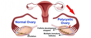 Polycystic Ovary Syndrome | American Pregnancy Association