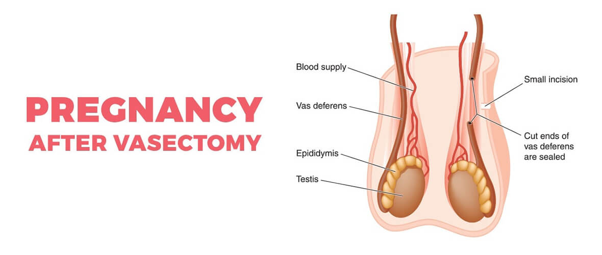 male-fertility-testing-after-vasectomy | American Pregnancy Association