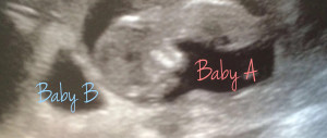vanishing-twins-syndrome-infographic-twins-sonogram | American Pregnancy Association
